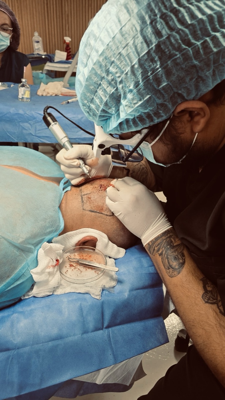 El Dr. Robles realizando la apertura de incisiones durante una práctica de microinjerto capilar en quirófano