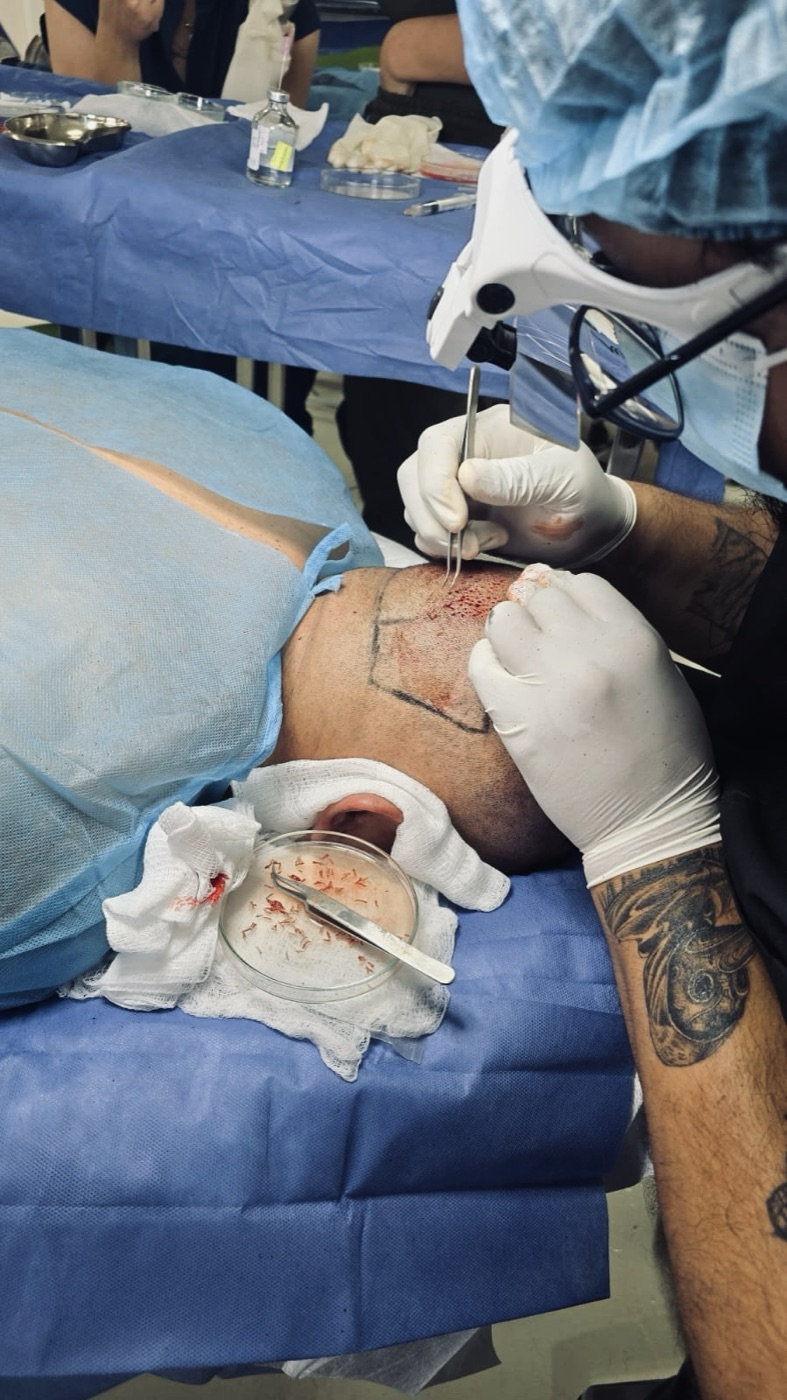 Implantación de unidades foliculares con pinzas durante una práctica de microinjerto capilar